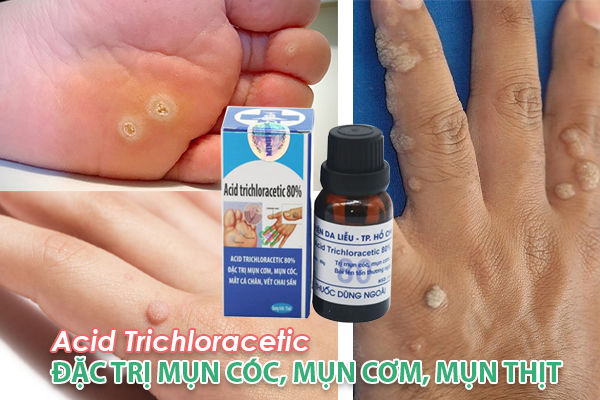 Hiệu quả của thuốc trị mụn cóc Acid Trichloracetic 80% đã được chứng minh Hiệu quả của thuốc trị mụn cóc Acid Trichloracetic 80% đã được chứng minh
